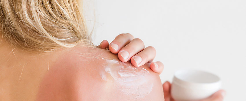 On woman's back skin smears cream after sun burn.